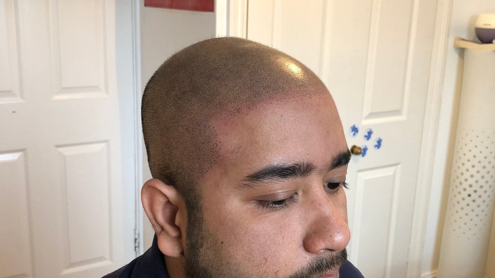 Restore Scalp Micropigmentation