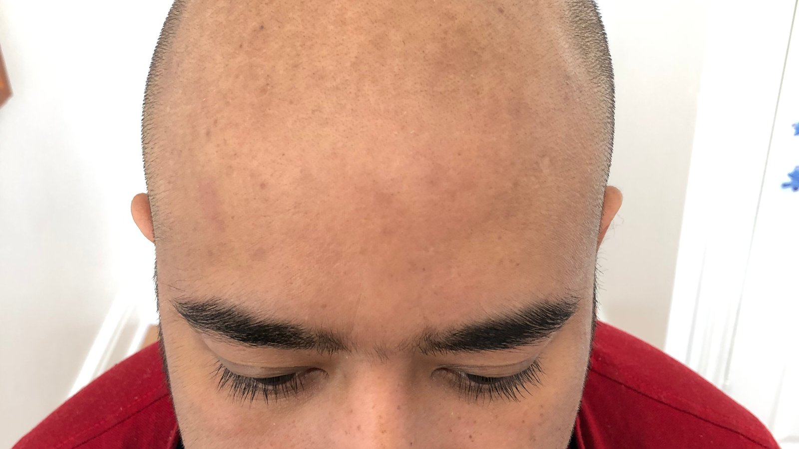 Restore Scalp Micropigmentation