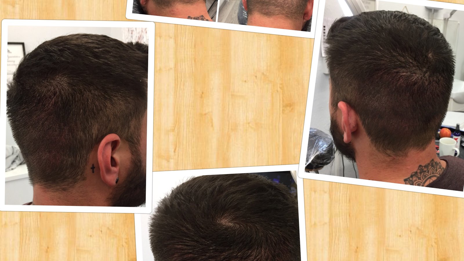 Follicle Illusion-Scalp Micropigmentation