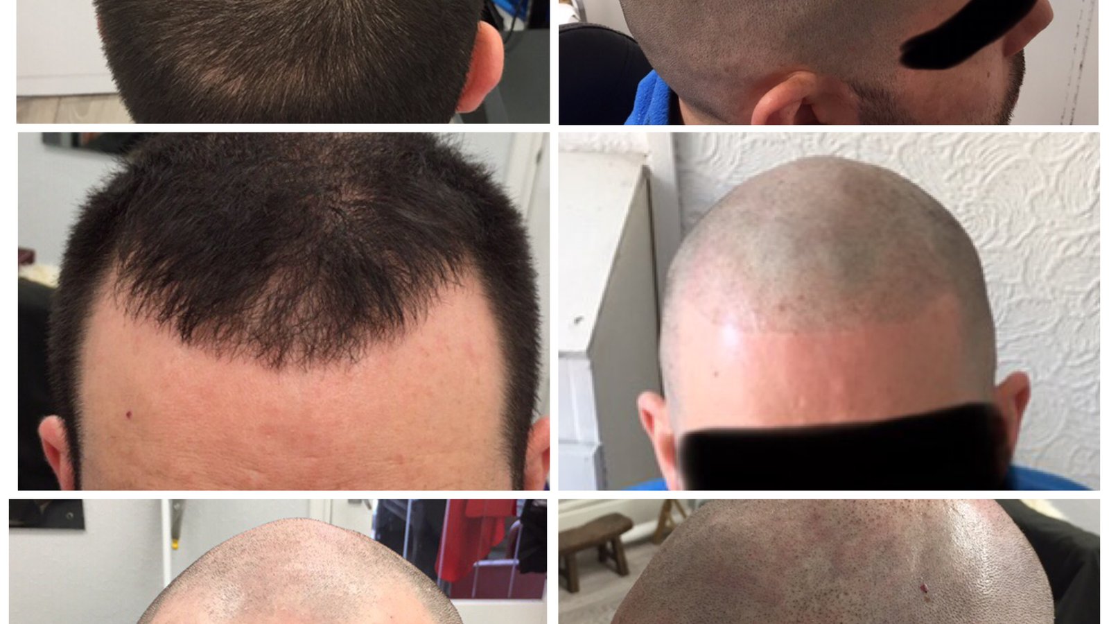 Follicle Illusion-Scalp Micropigmentation