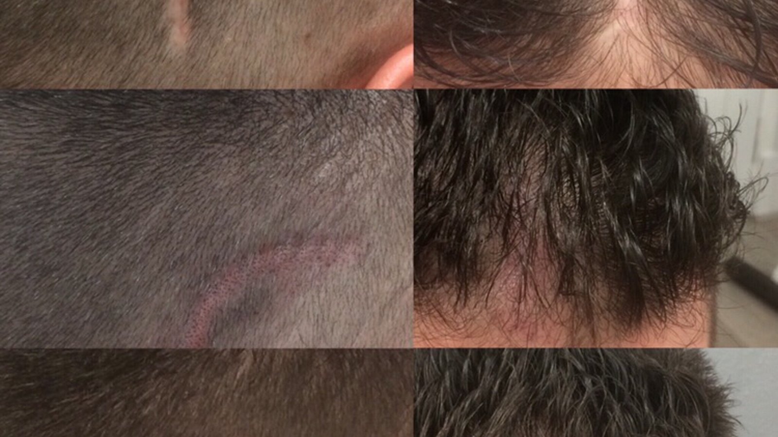 Follicle Illusion-Scalp Micropigmentation