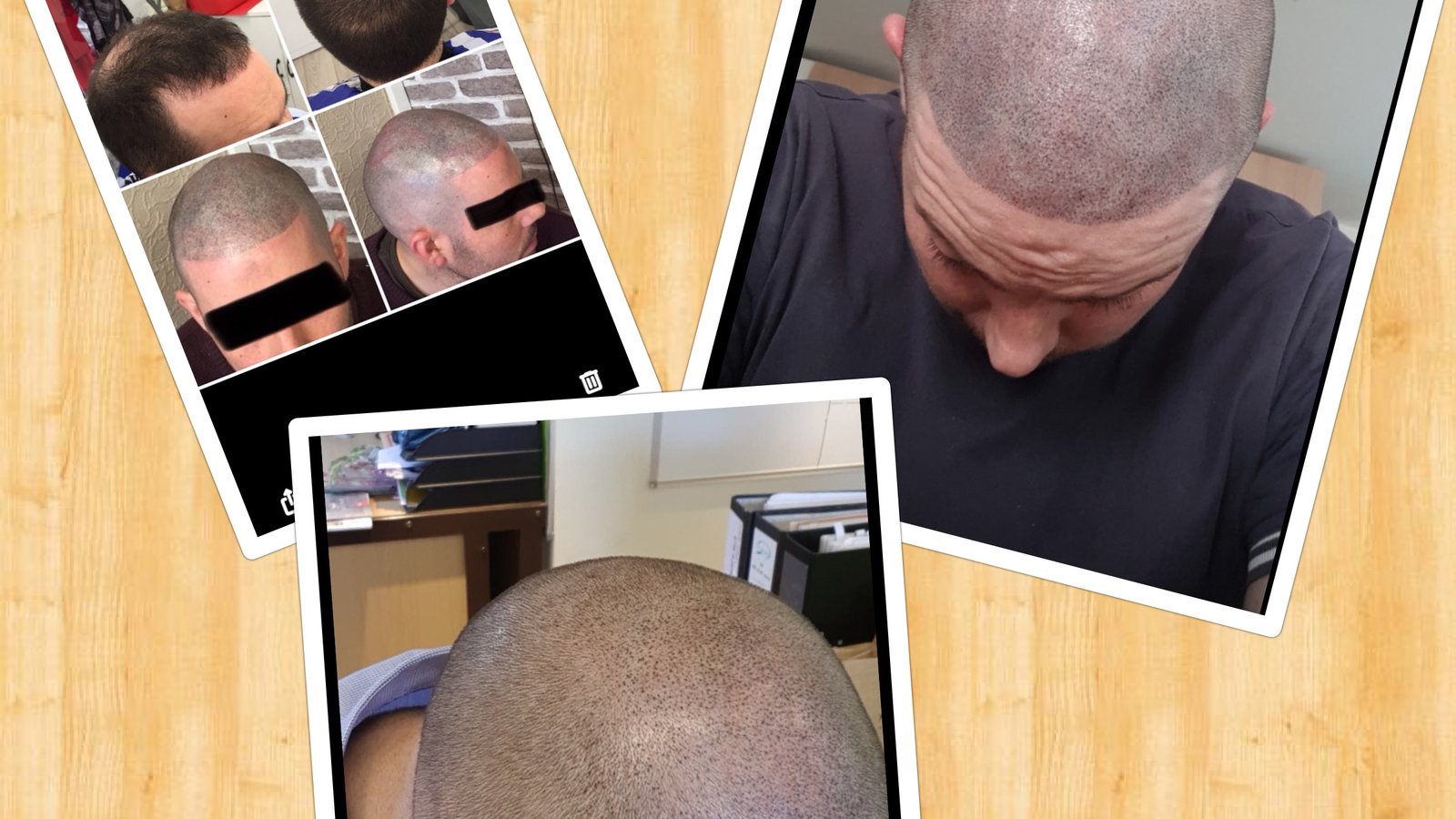 Follicle Illusion-Scalp Micropigmentation