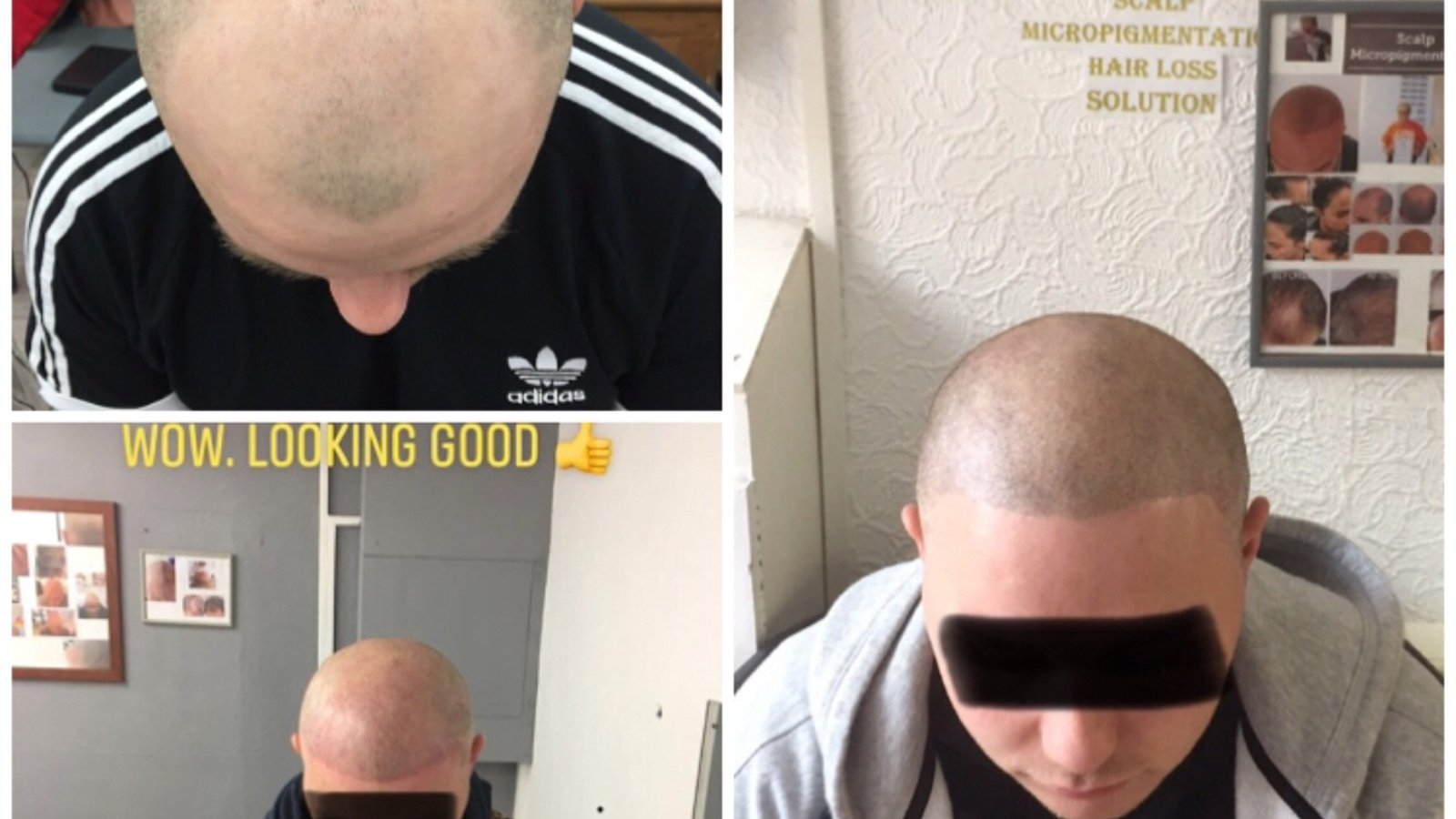 Follicle Illusion-Scalp Micropigmentation