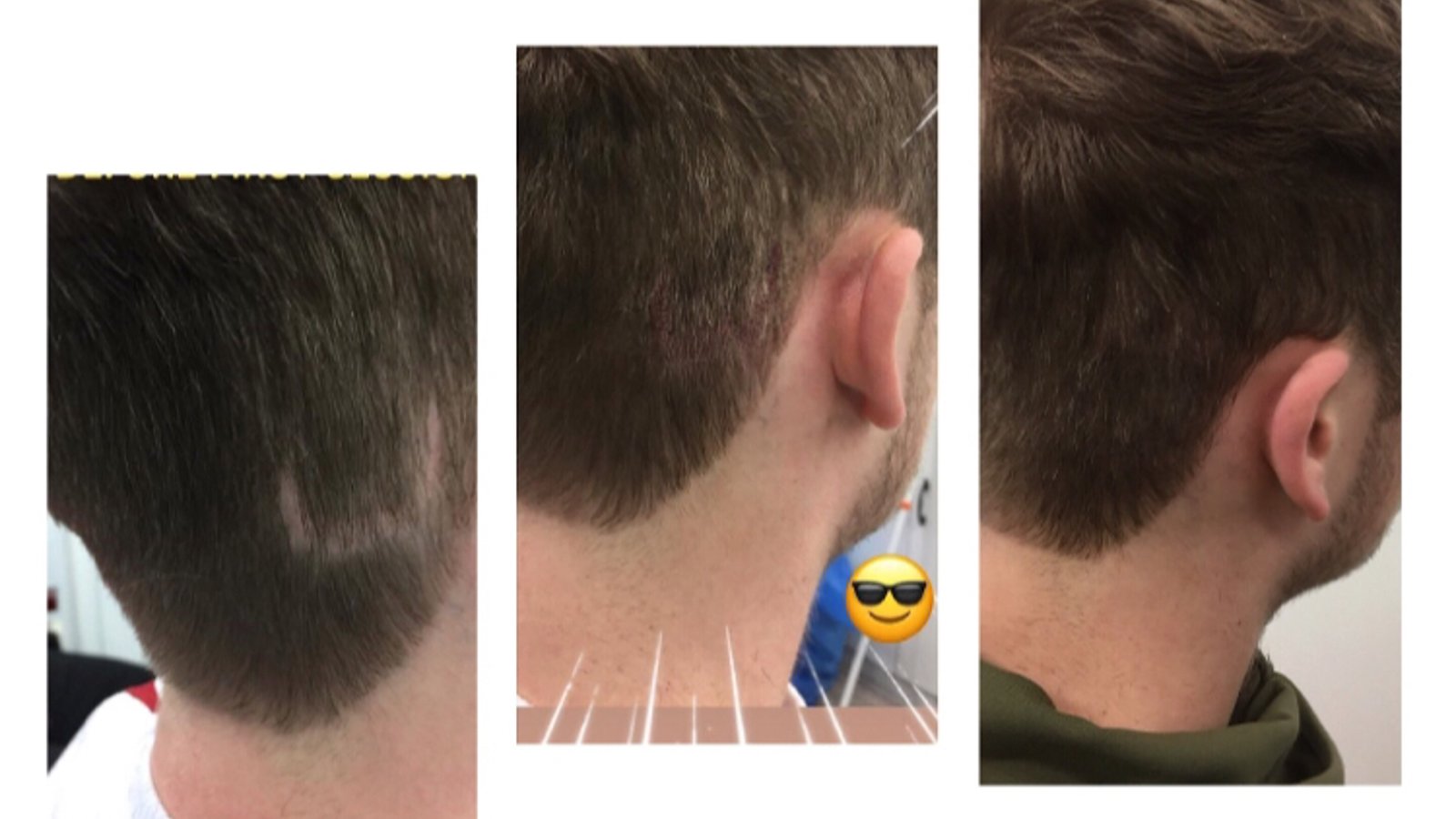 Follicle Illusion-Scalp Micropigmentation