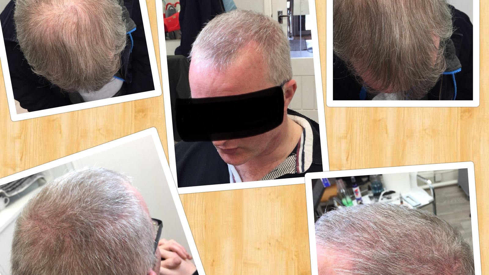 Follicle Illusion-Scalp Micropigmentation