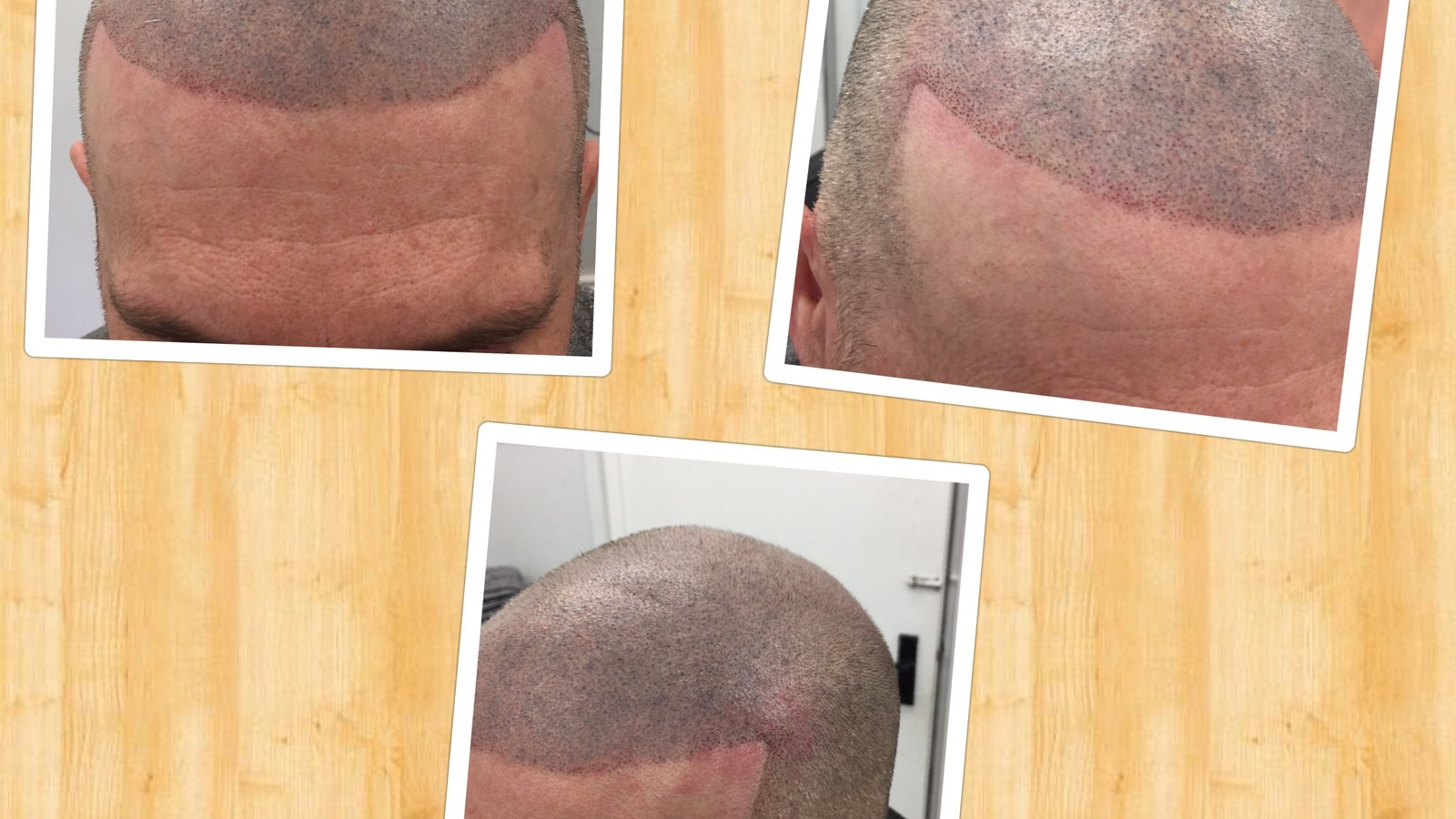 Follicle Illusion-Scalp Micropigmentation