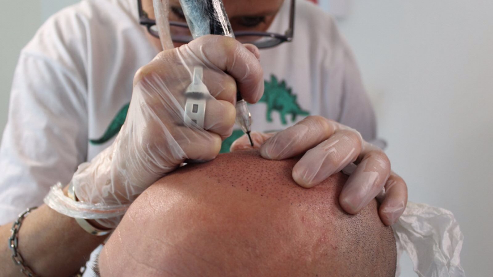 Follicle Illusion-Scalp Micropigmentation