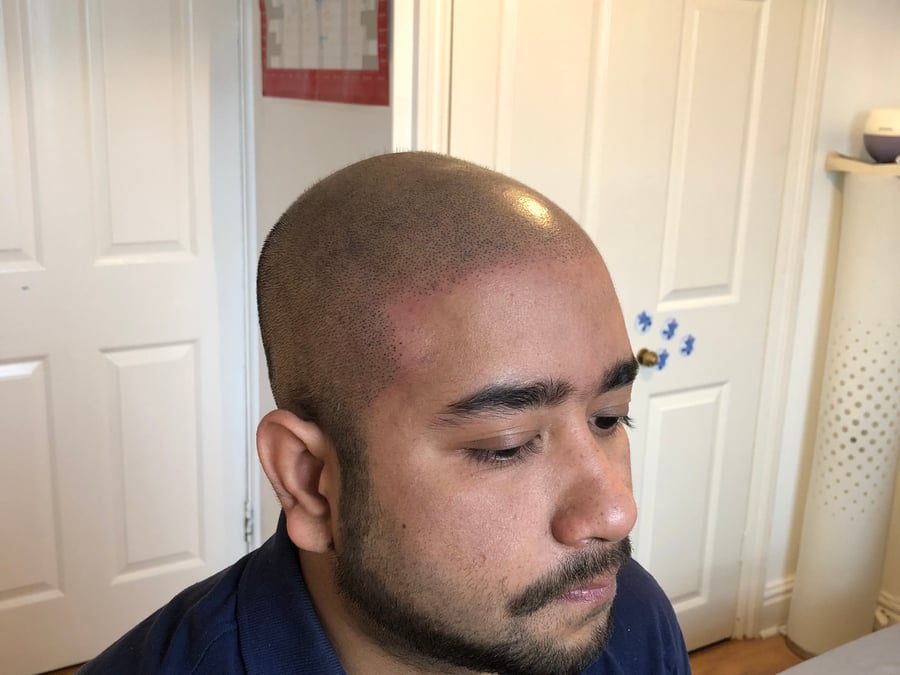 Restore Scalp Micropigmentation