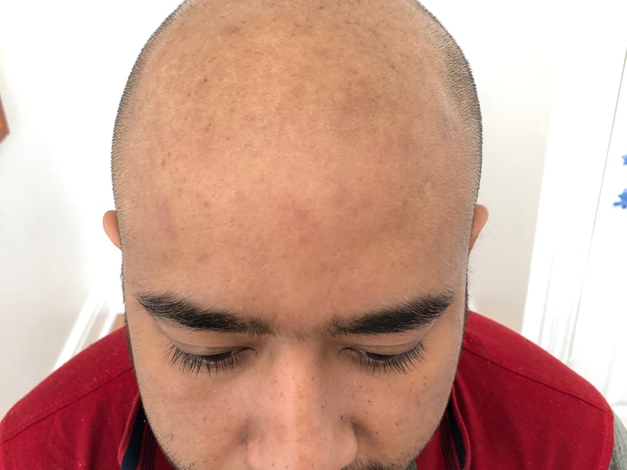 Restore Scalp Micropigmentation
