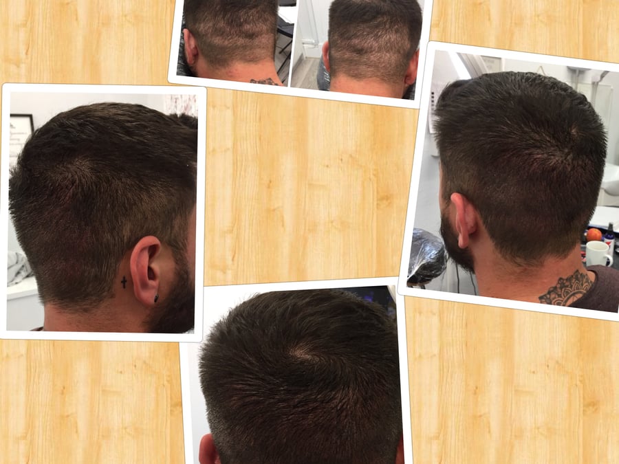 Follicle Illusion-Scalp Micropigmentation