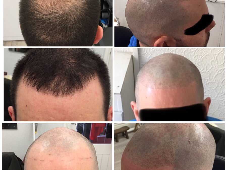 Follicle Illusion-Scalp Micropigmentation