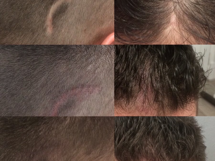 Follicle Illusion-Scalp Micropigmentation
