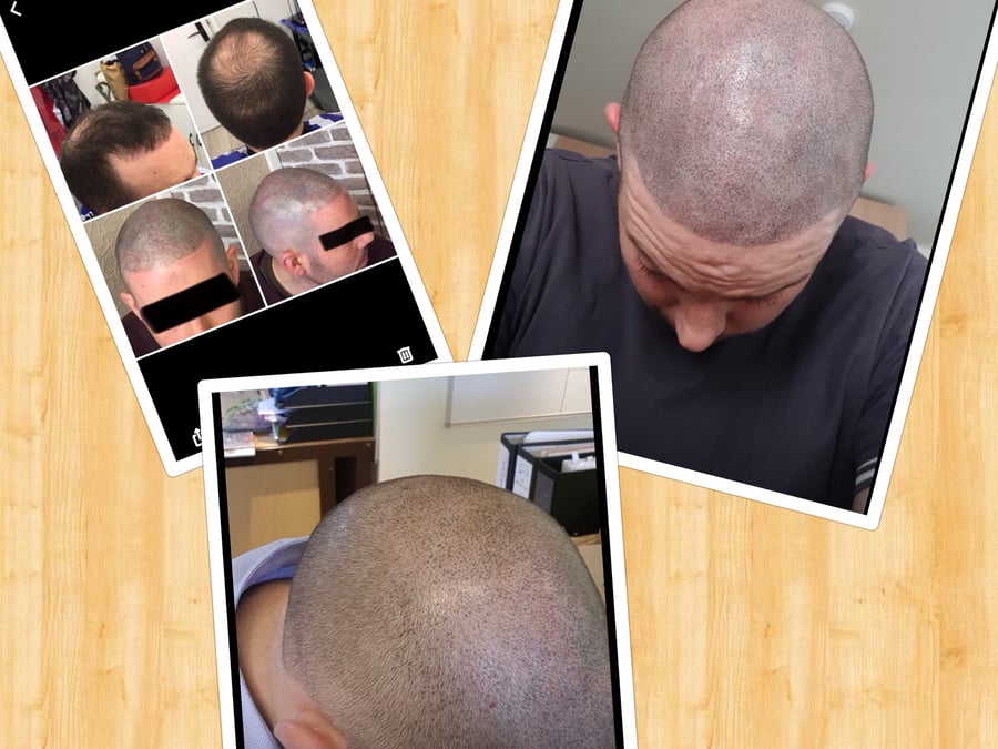 Follicle Illusion-Scalp Micropigmentation
