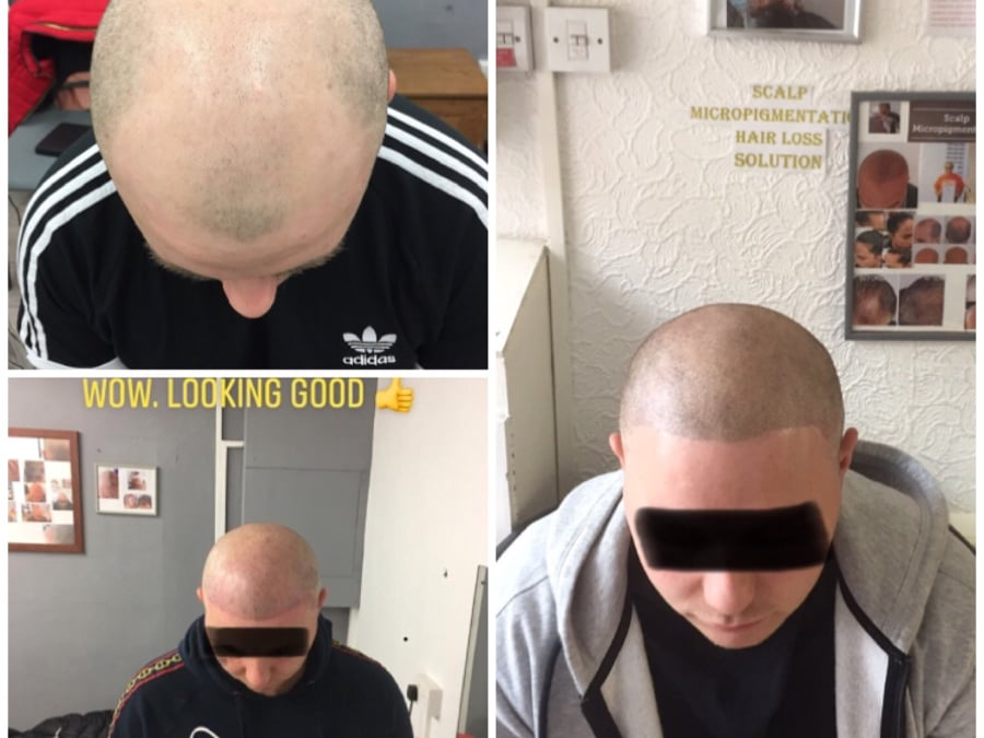 Follicle Illusion-Scalp Micropigmentation