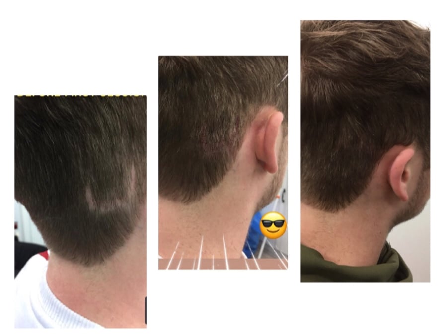 Follicle Illusion-Scalp Micropigmentation