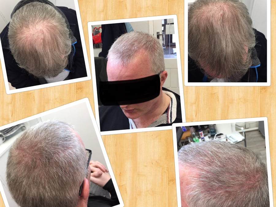 Follicle Illusion-Scalp Micropigmentation