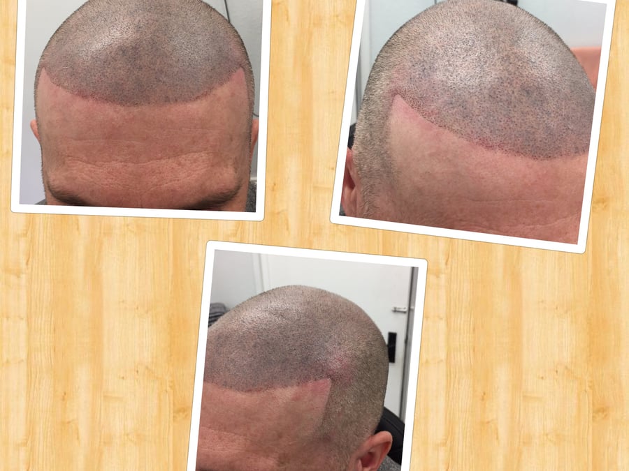 Follicle Illusion-Scalp Micropigmentation