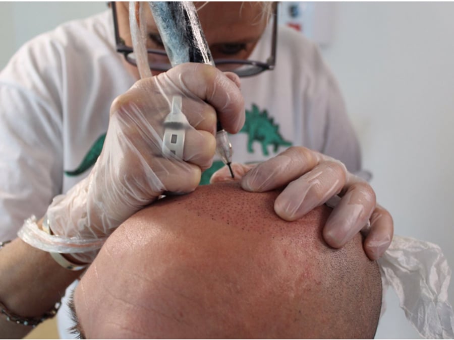 Follicle Illusion-Scalp Micropigmentation